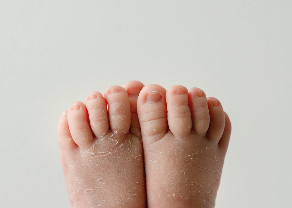 baby toes with flaky newborn skin